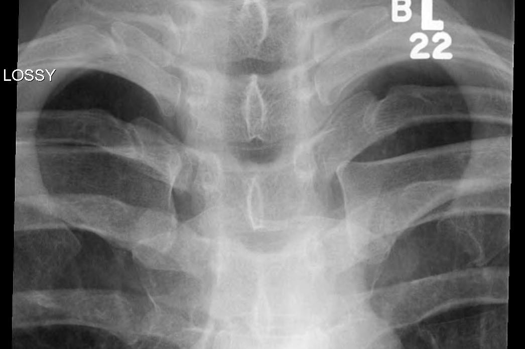 Sternoclavicular Joint Xray 1